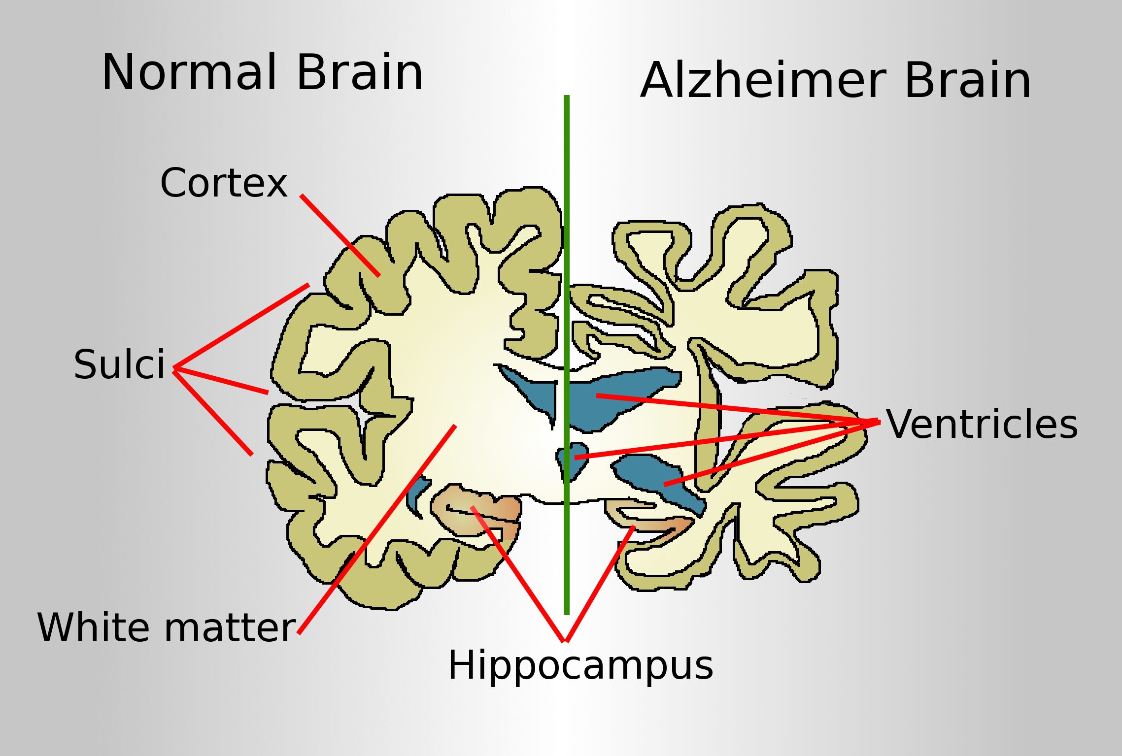 Alzheimer's