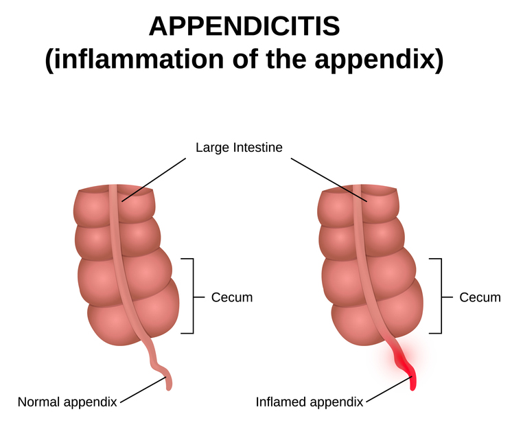 Appendicitis