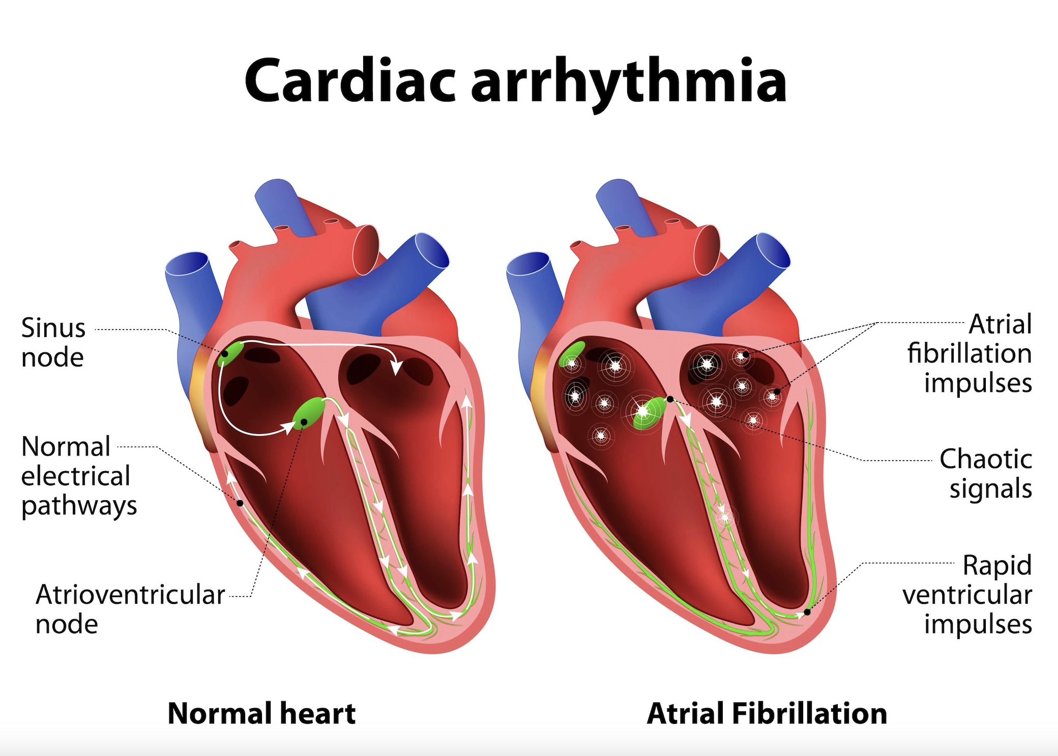 Arrhythmia