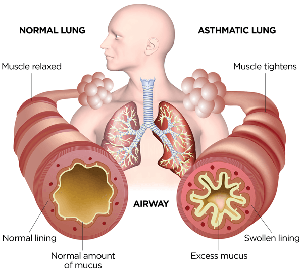 Asthma