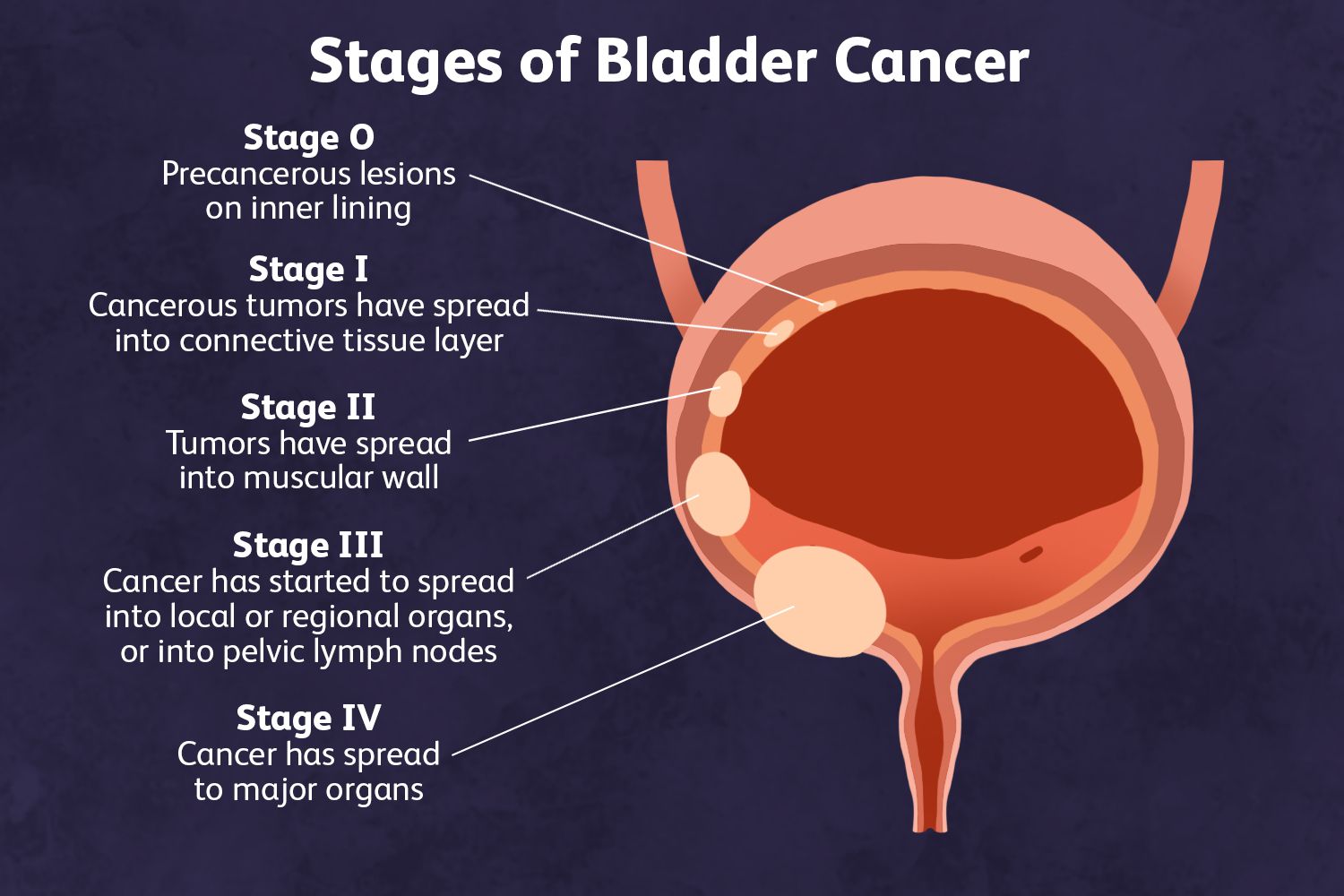 Bladder Cancer