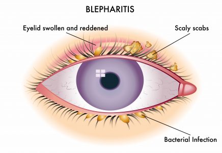 inflammation of the eyelids