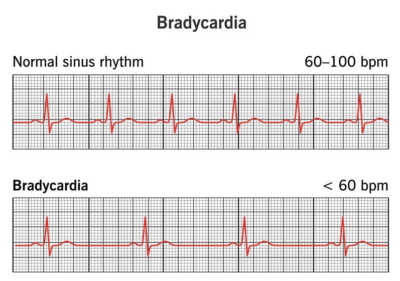 Bradycardia