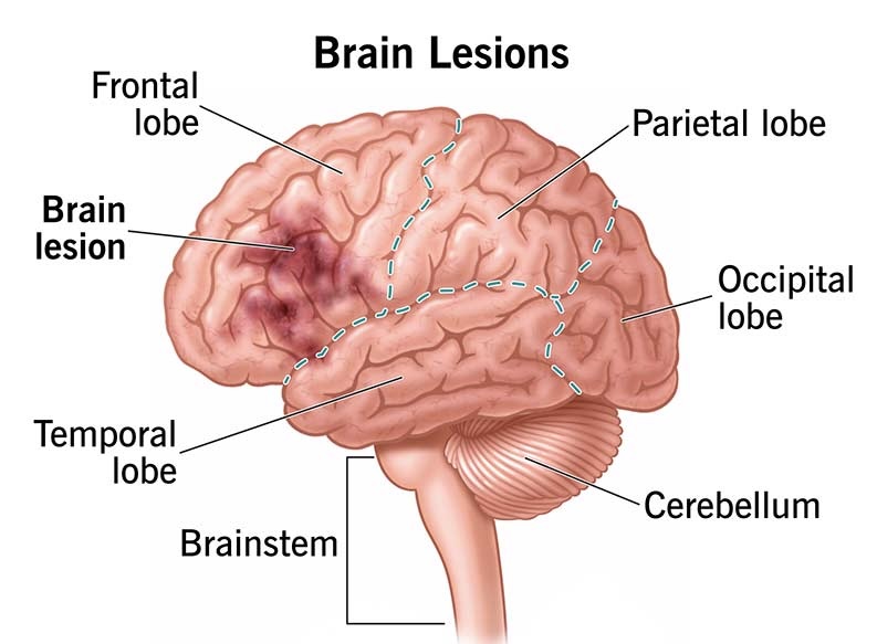 Brain Lesions