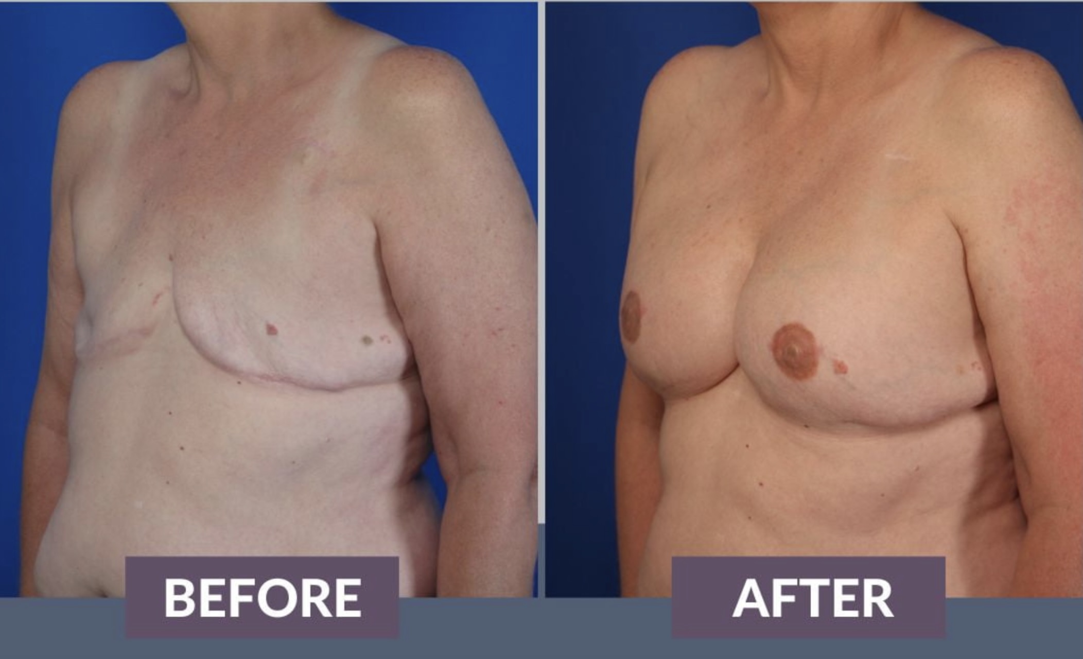 Breast Reconstruction