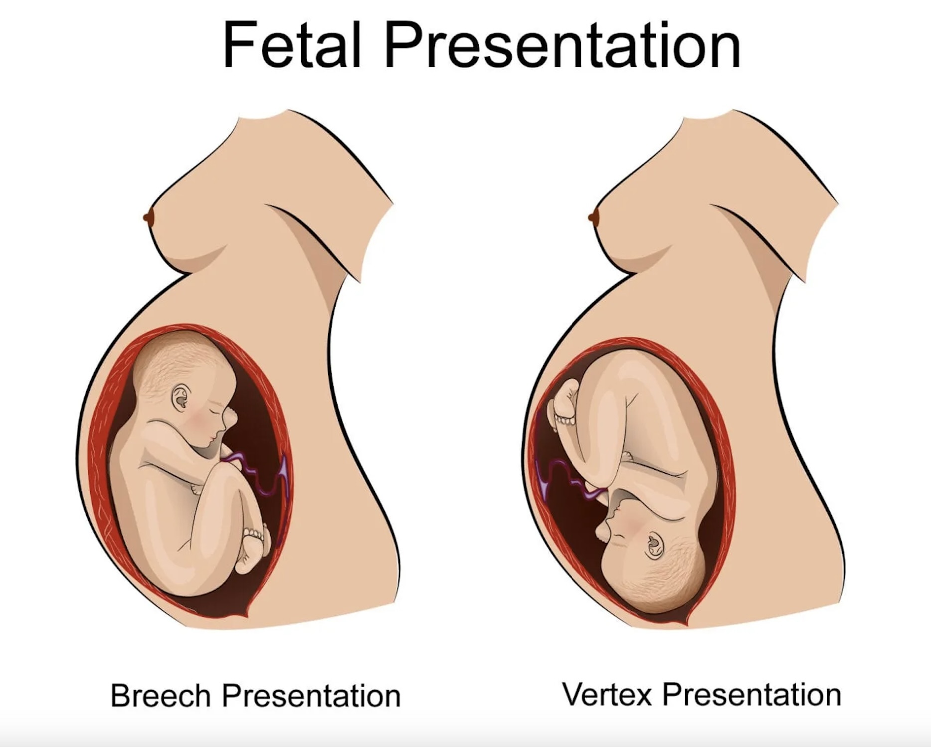 Breech Birth