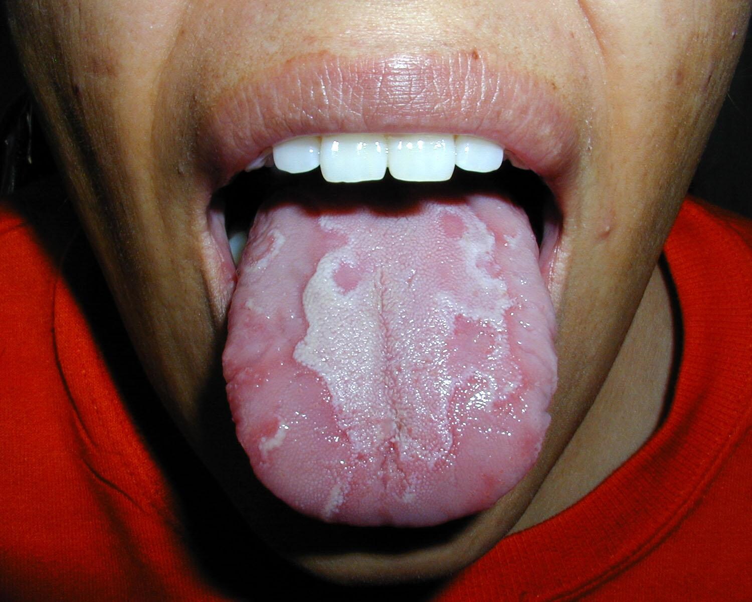 Burning Mouth Syndrome