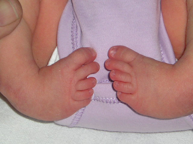 clubfoot