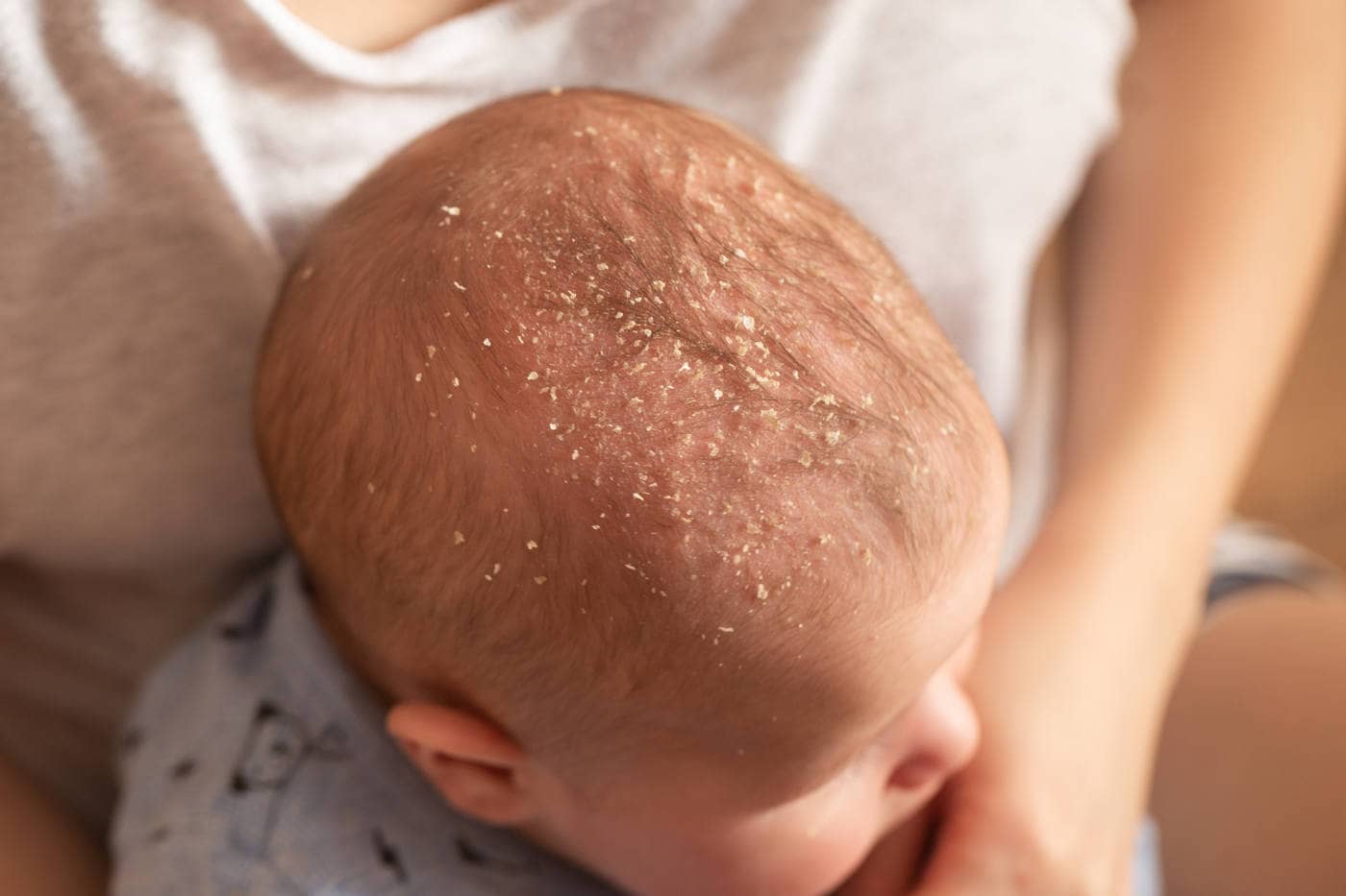 Cradle Cap