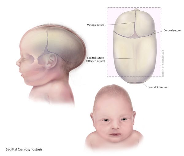 Craniosynostosis