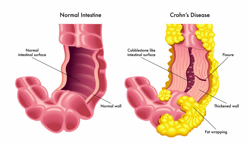 Crohn’s Disease