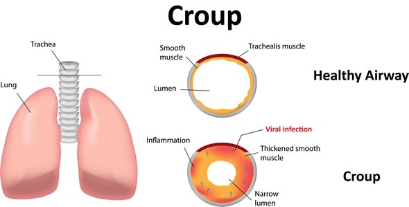 Croup