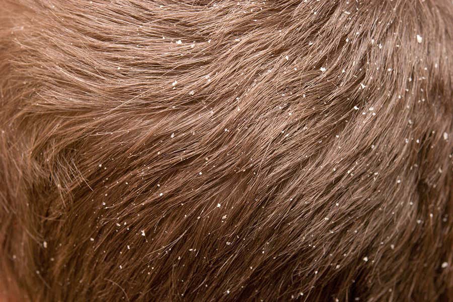 Dandruff