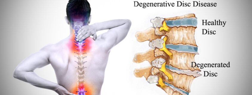 Degenerative Disc Disease