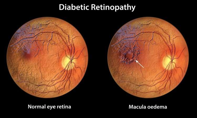 Diabetic Macular Edema