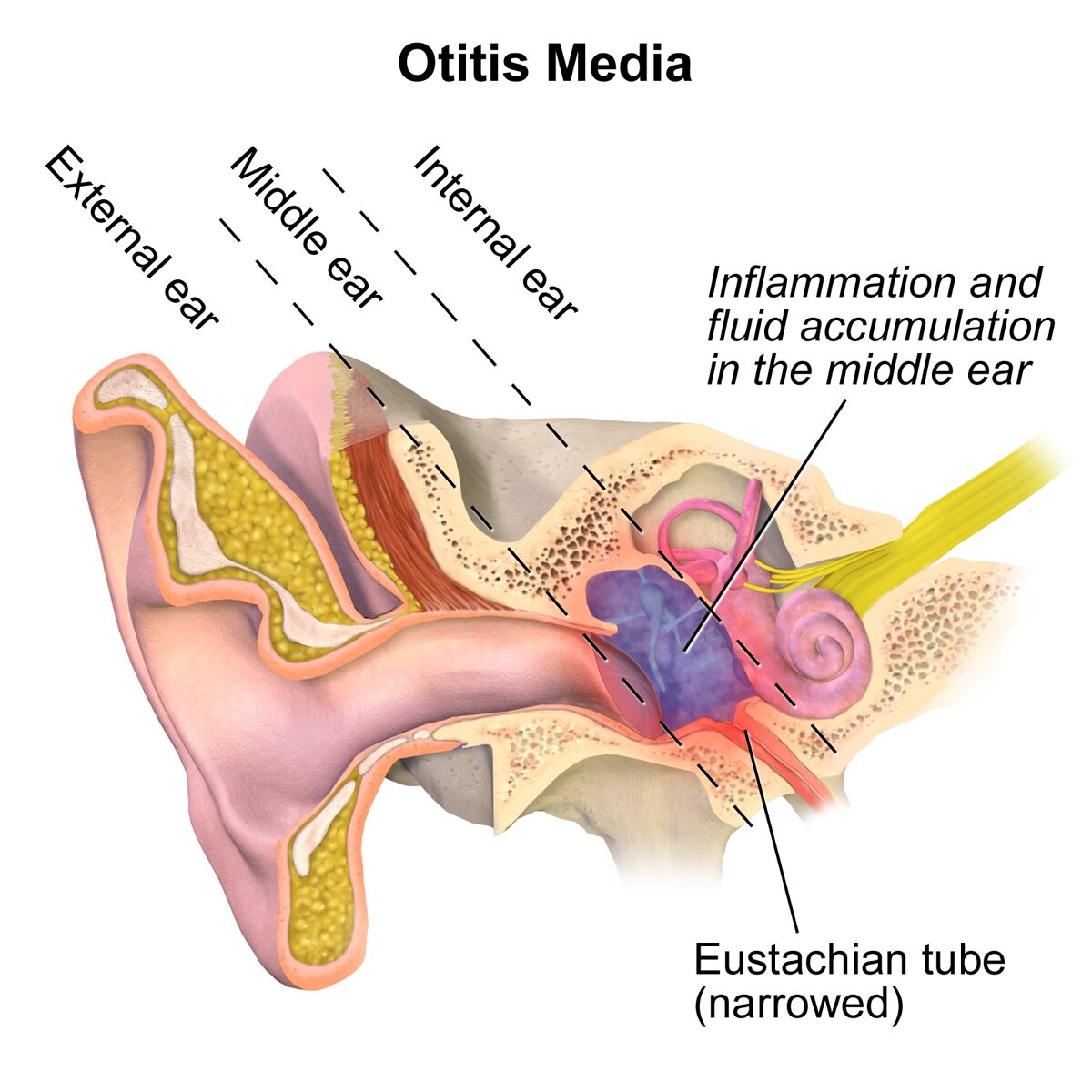 Ear Infection