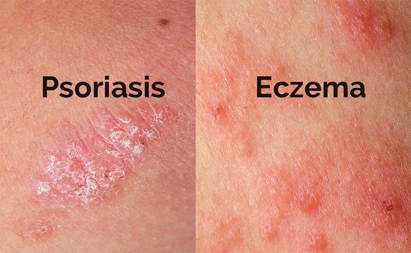 Eczema vs Psoriasis