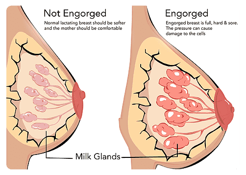 Engorgement