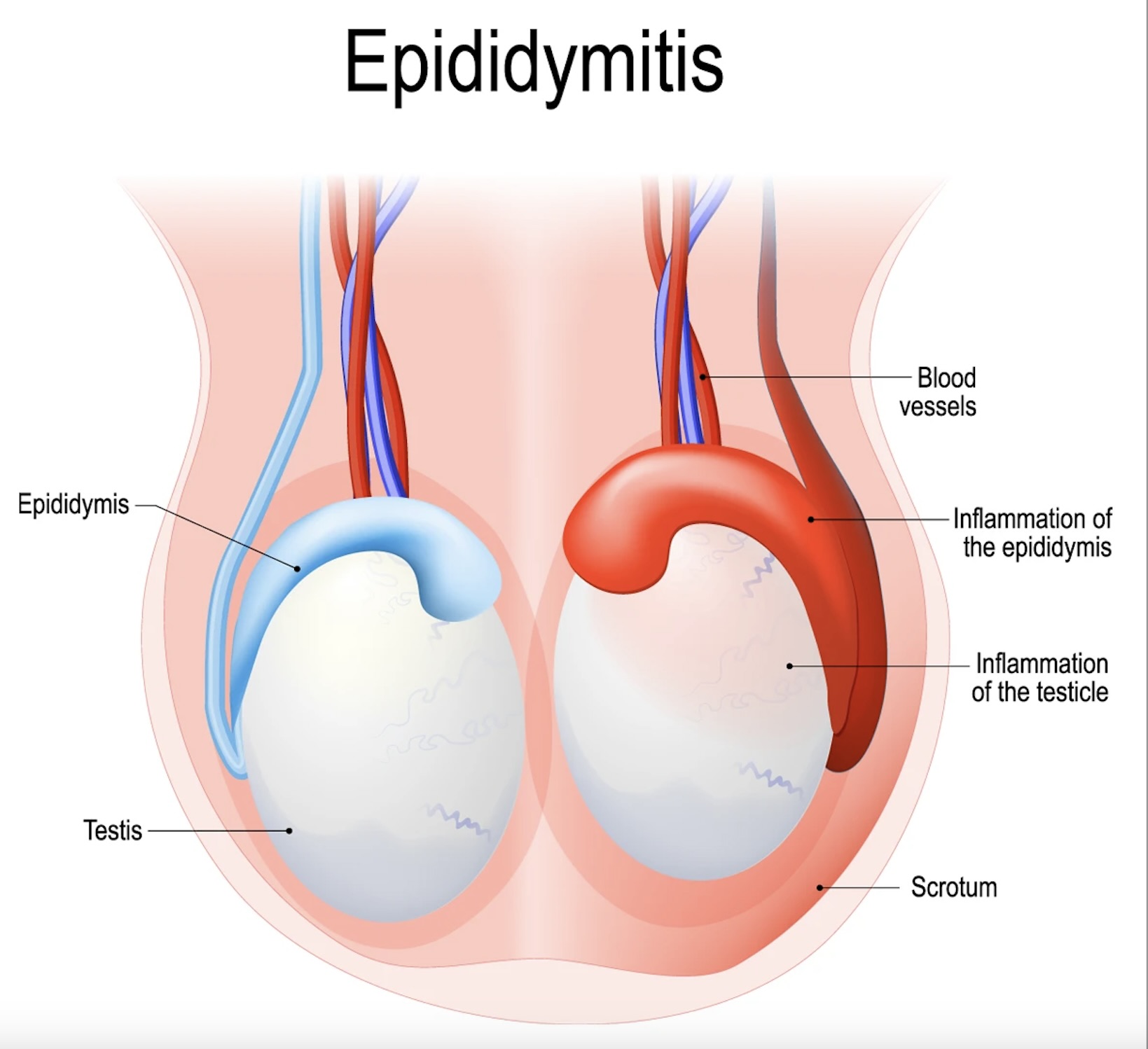 Epididymitis