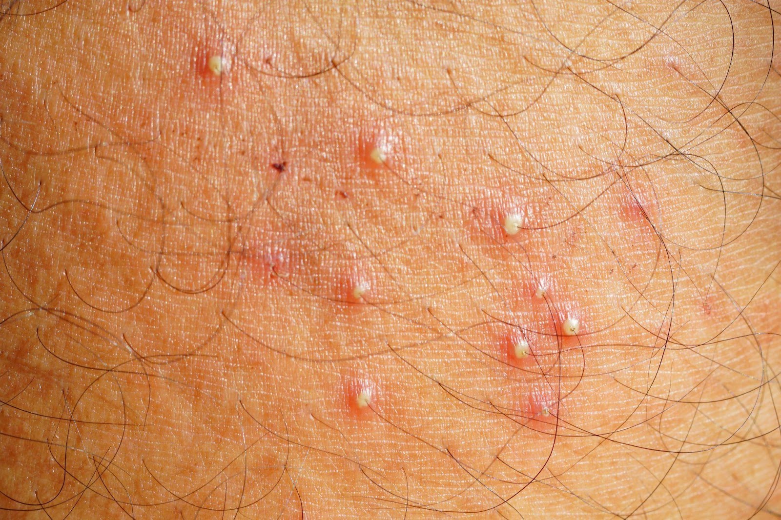 Folliculitis