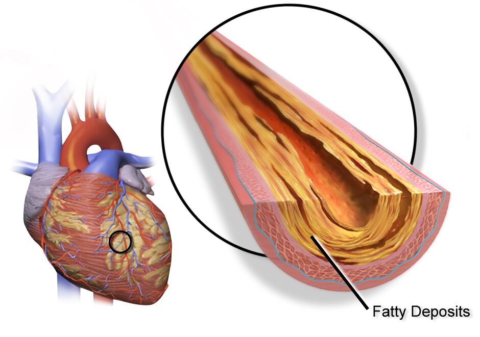 Heart Disease 