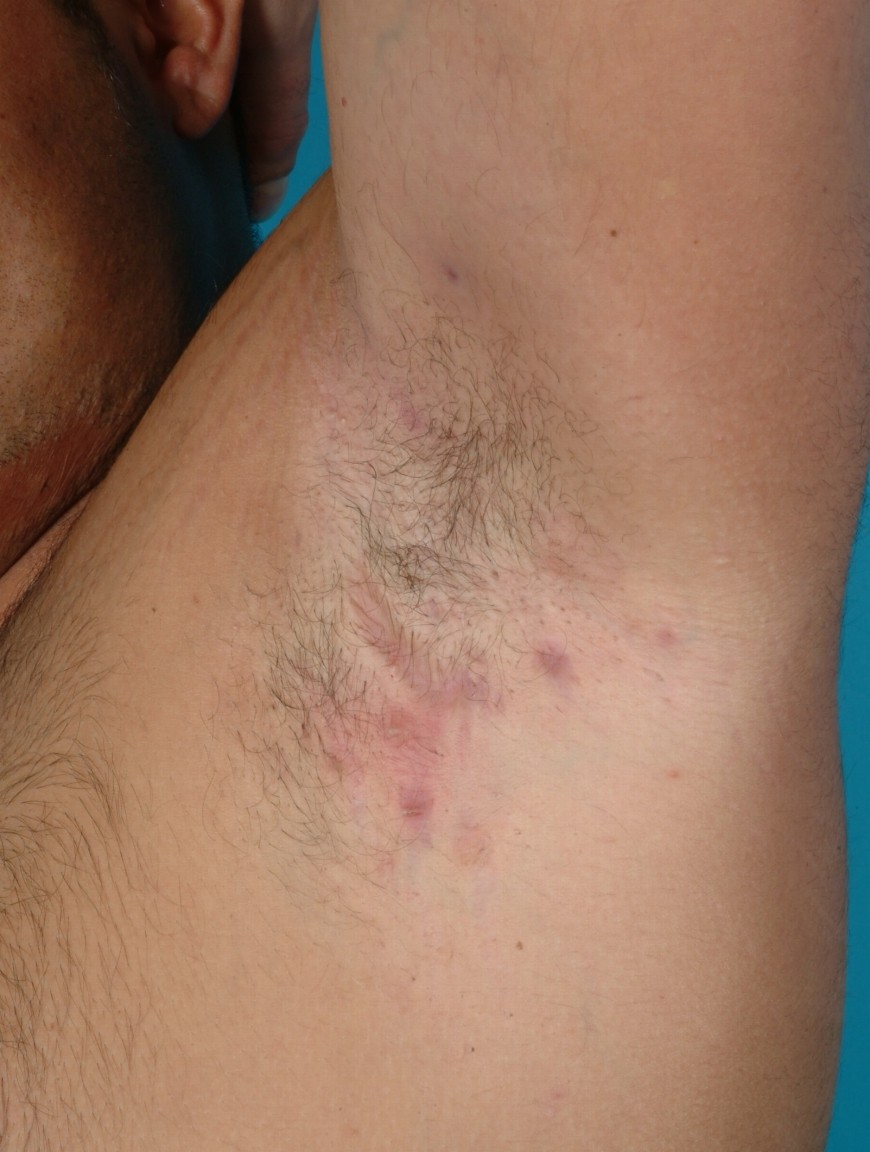 Hidradenitis suppurativa