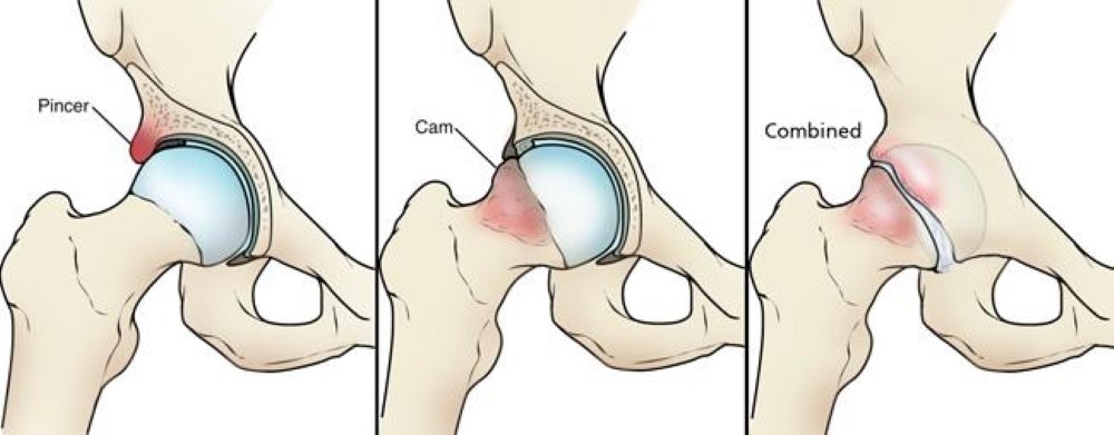 Hip Impingement