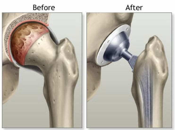 Hip replacement surgery