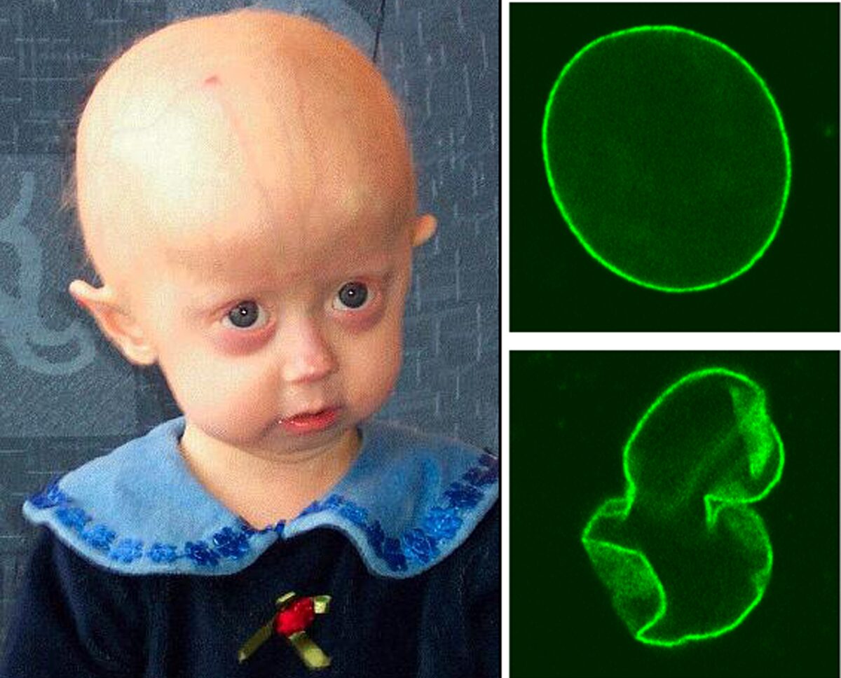 Hutchinson-Gilford progeria syndrome