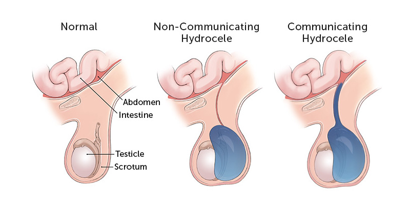 Hydrocele