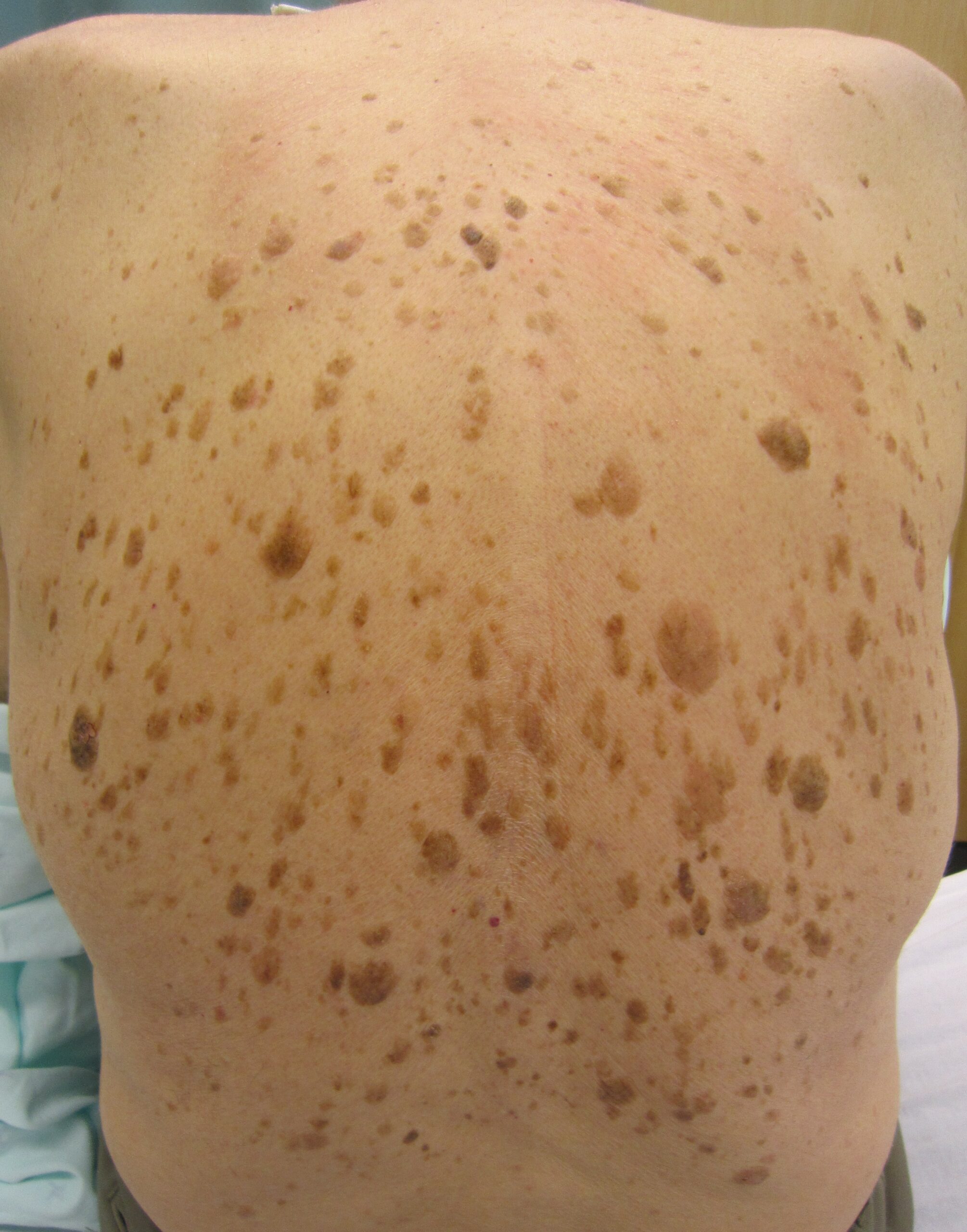 Keratosis Seborrheic