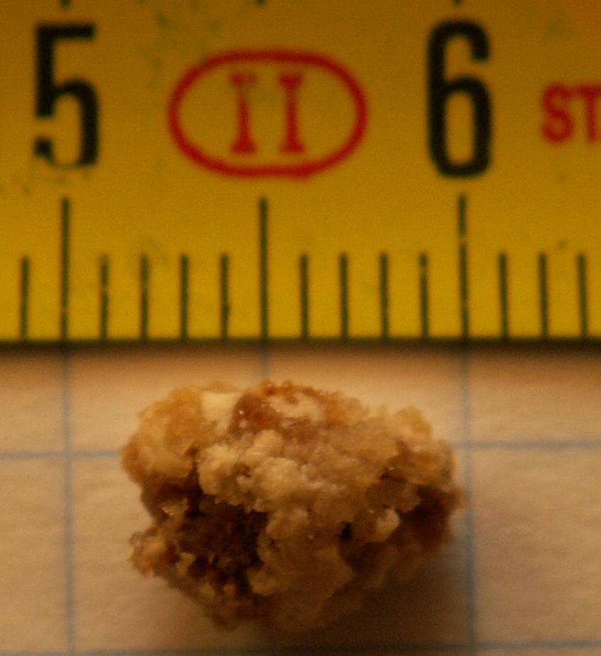 Kidney Stones