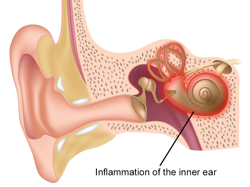 Labyrinthitis