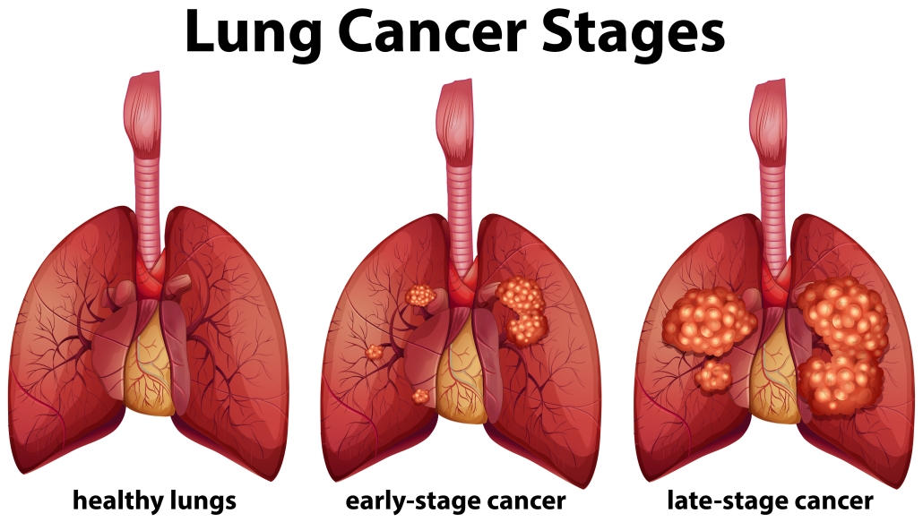 Lung Cancer Stages