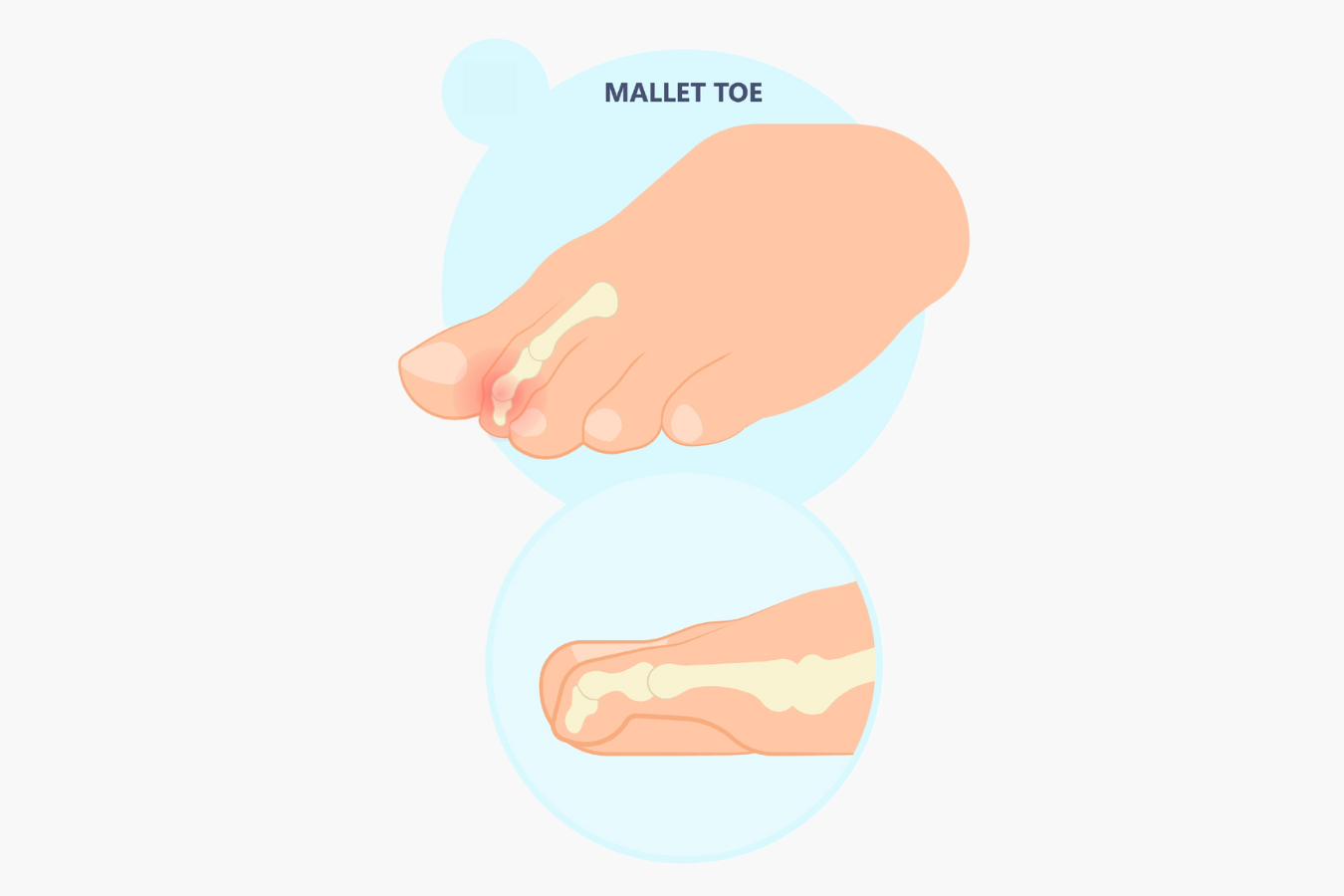 Mallet Toe