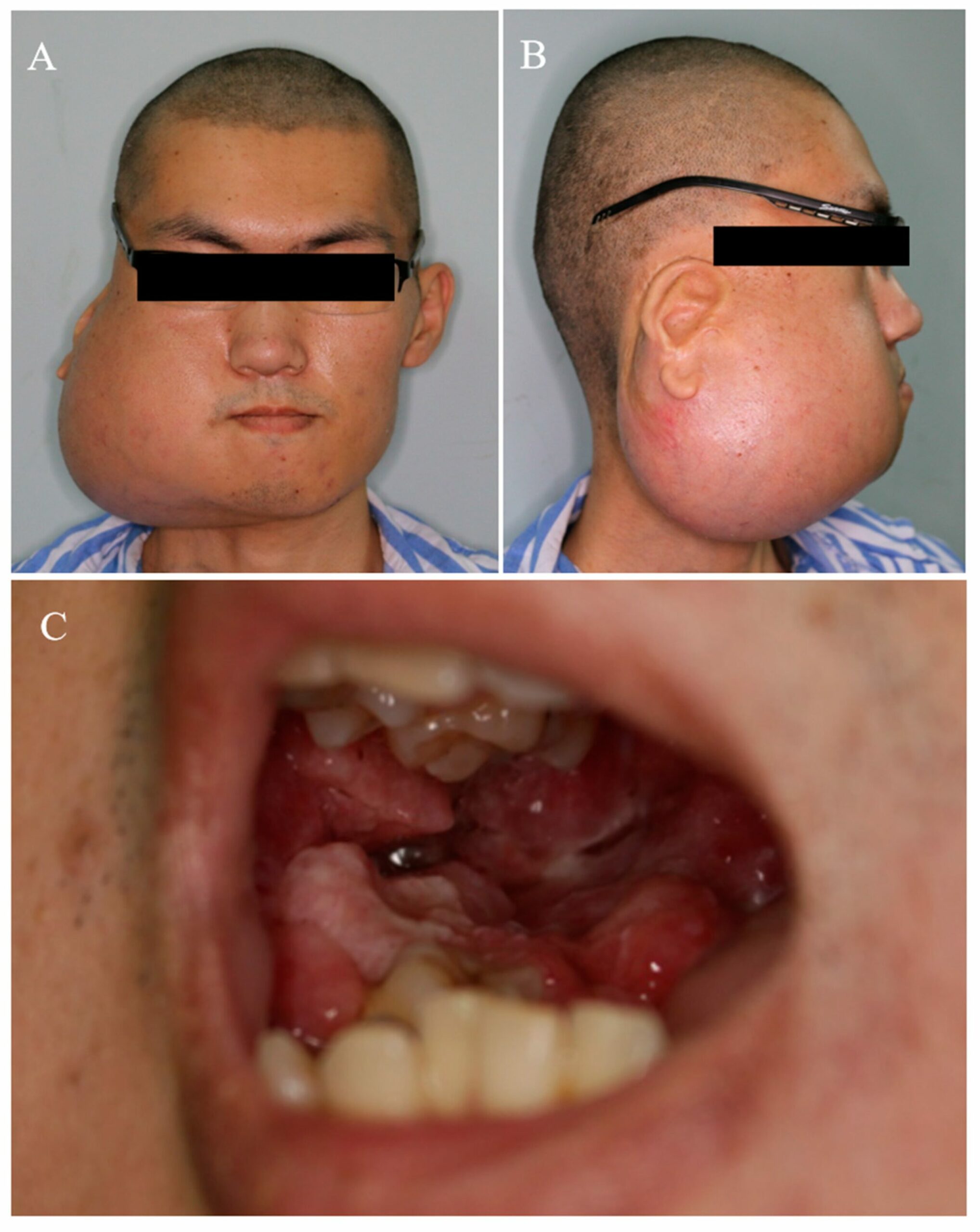 Mandibular Ameloblastoma