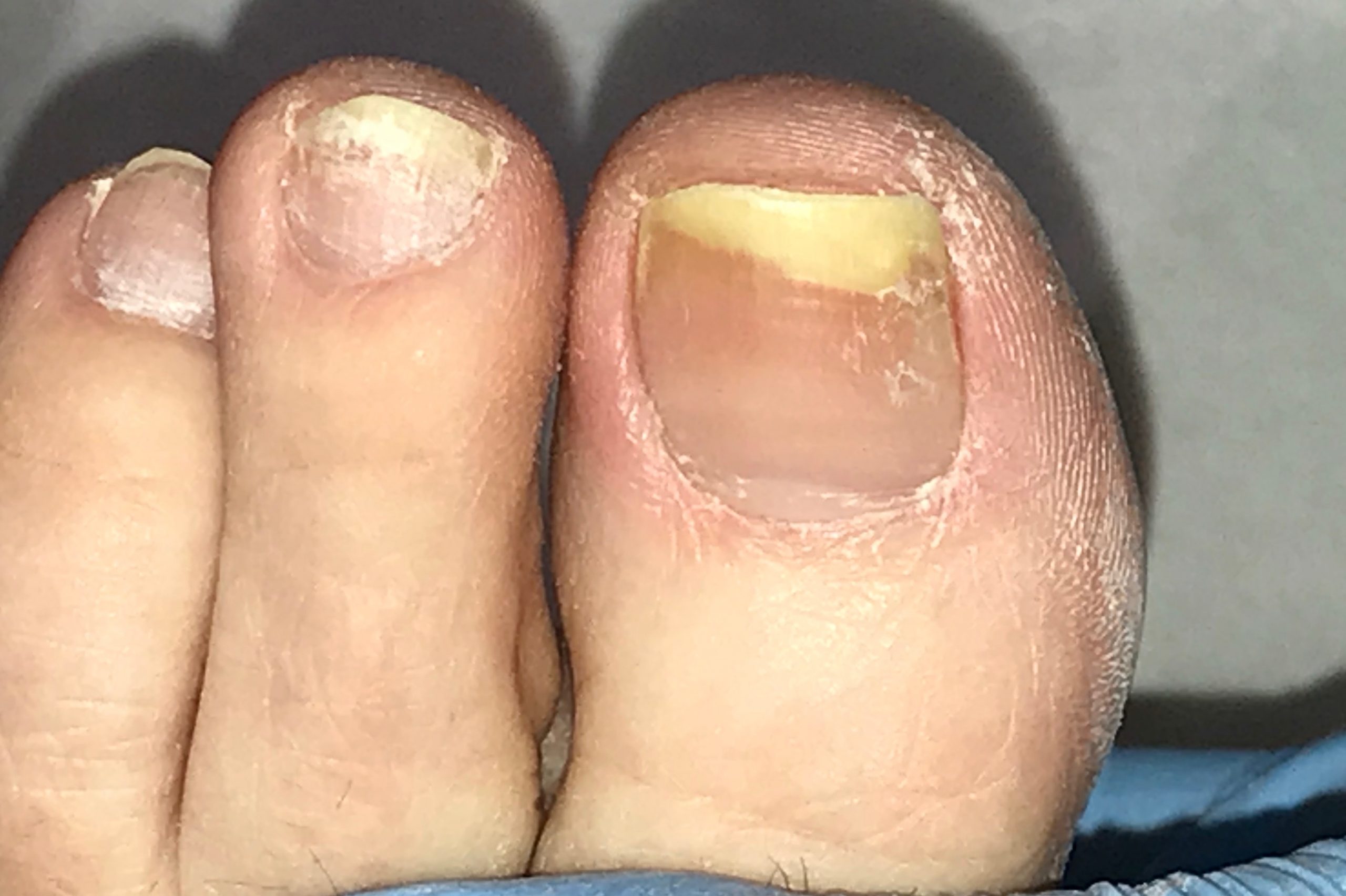 Nail Fungus