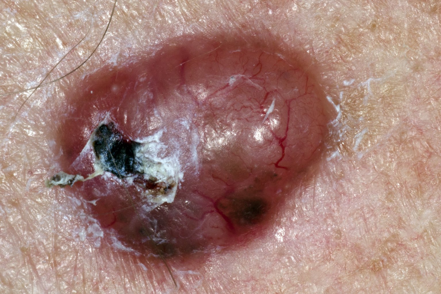 Non-melanoma skin cancer