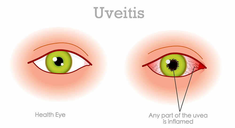 Noninfectious Uveitis