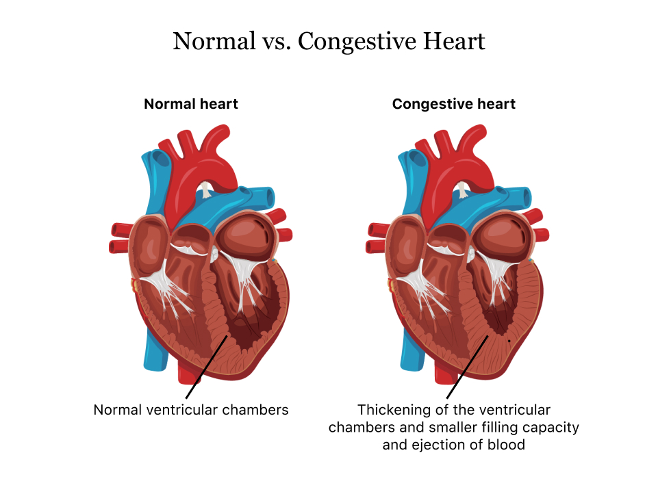 Normal vs.Congestive-Heart