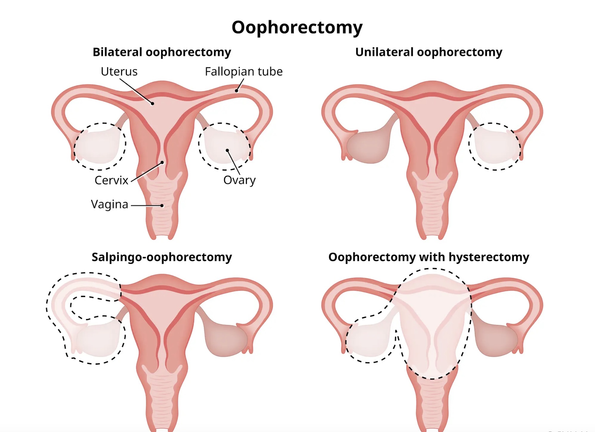 Oophorectomy