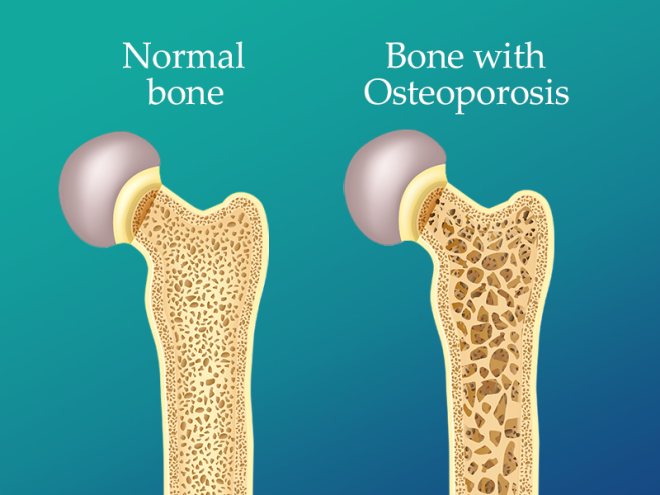 Osteoporosis