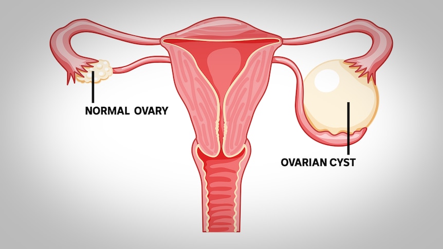 Ovarian Cyst