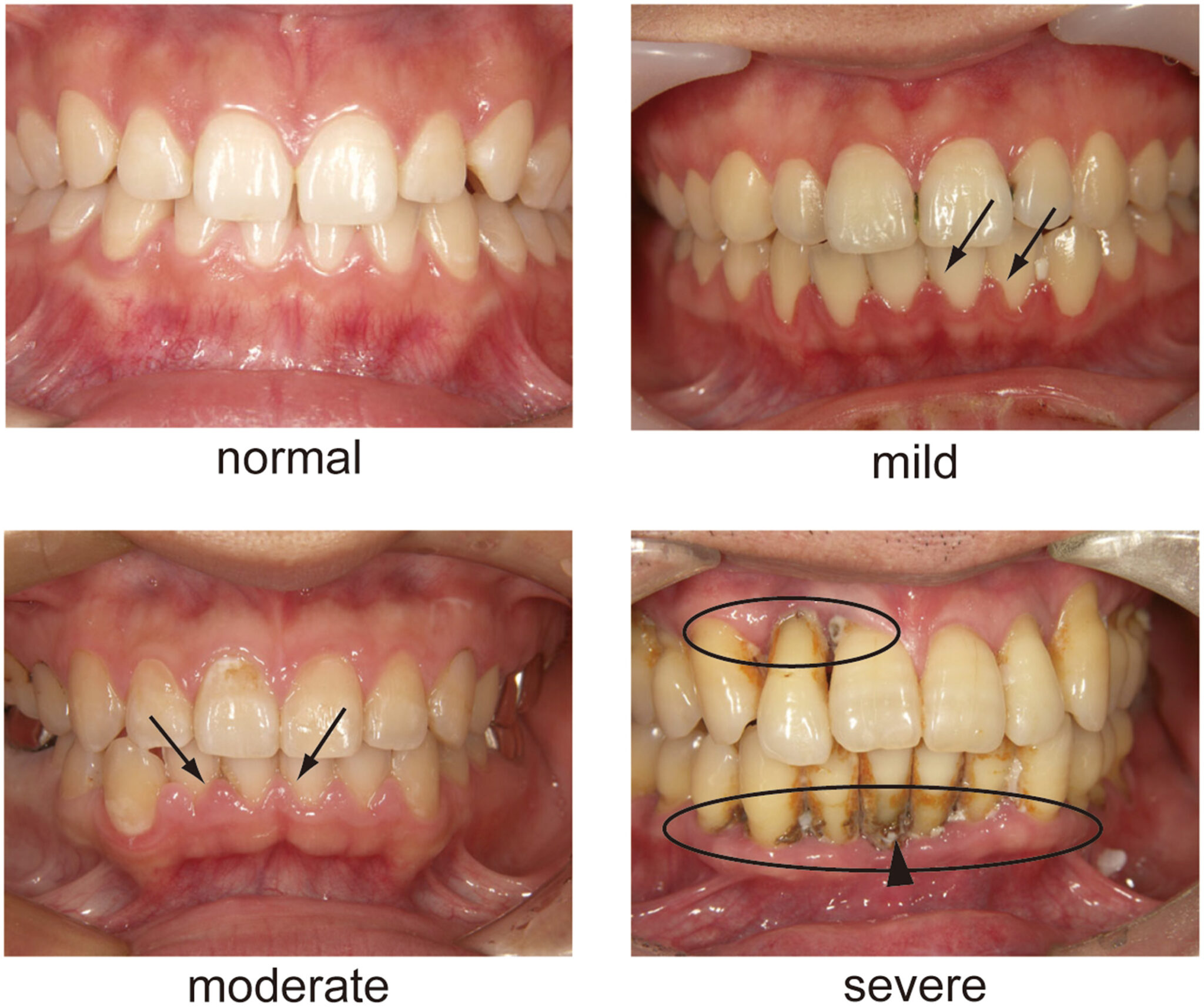 Periodontal Disease