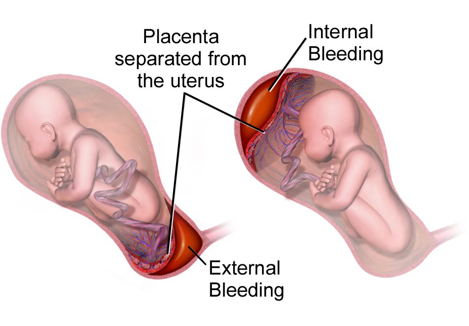 Placental Abruption