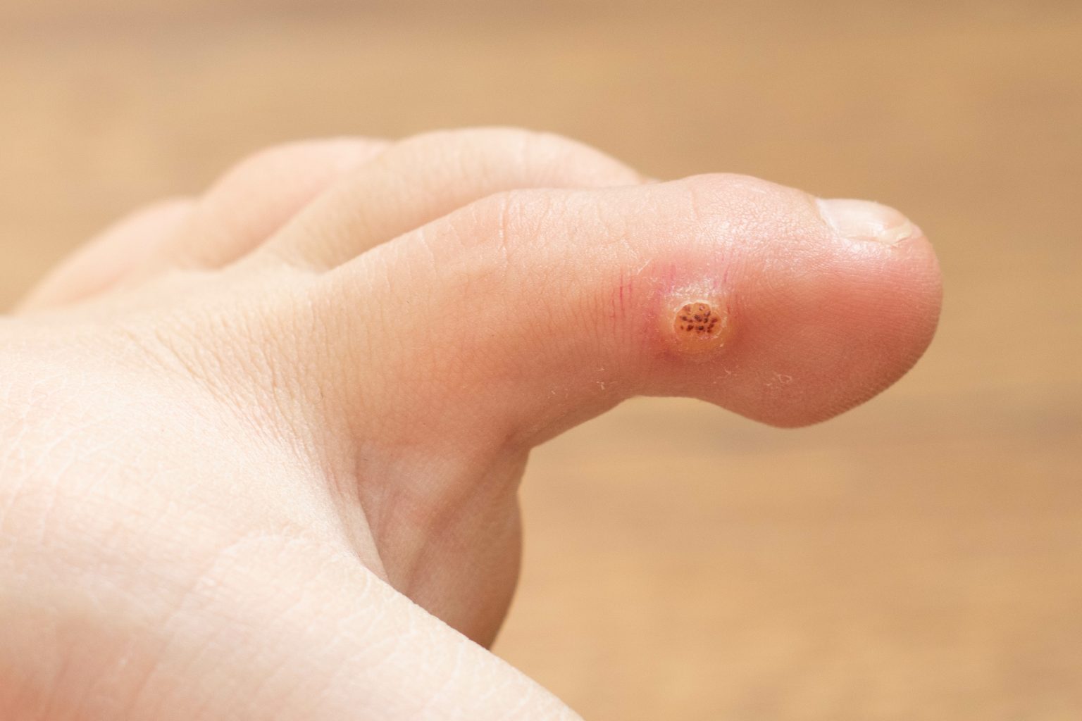 Plantar Warts