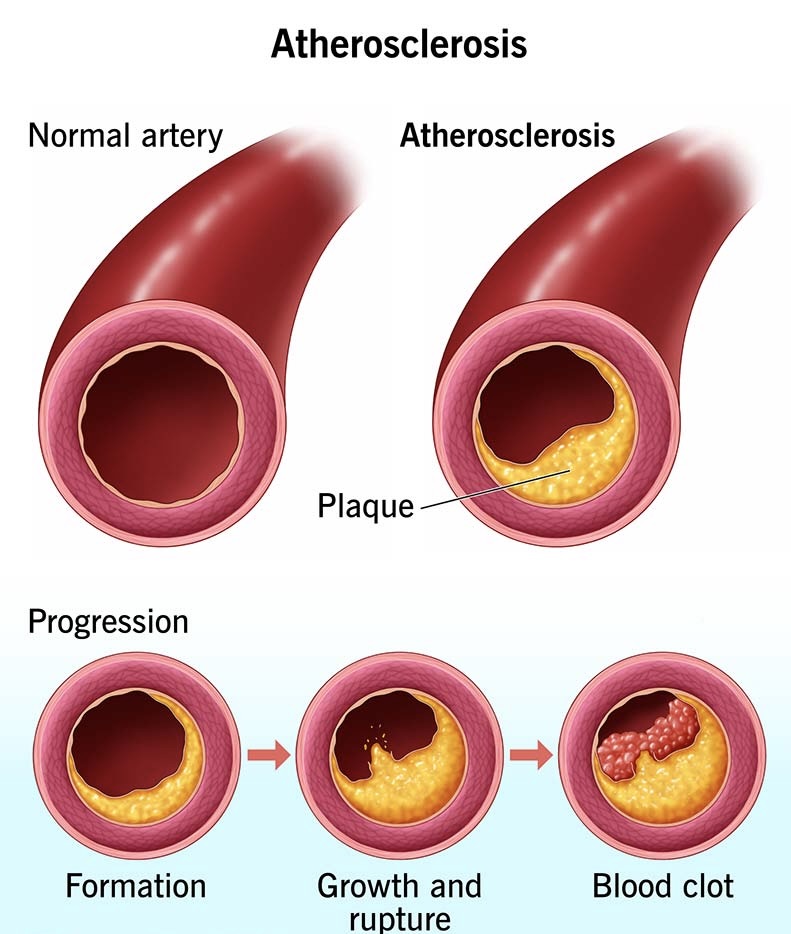 Plaque in Arteries