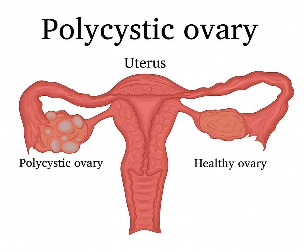 Polycystic Ovary Syndrome