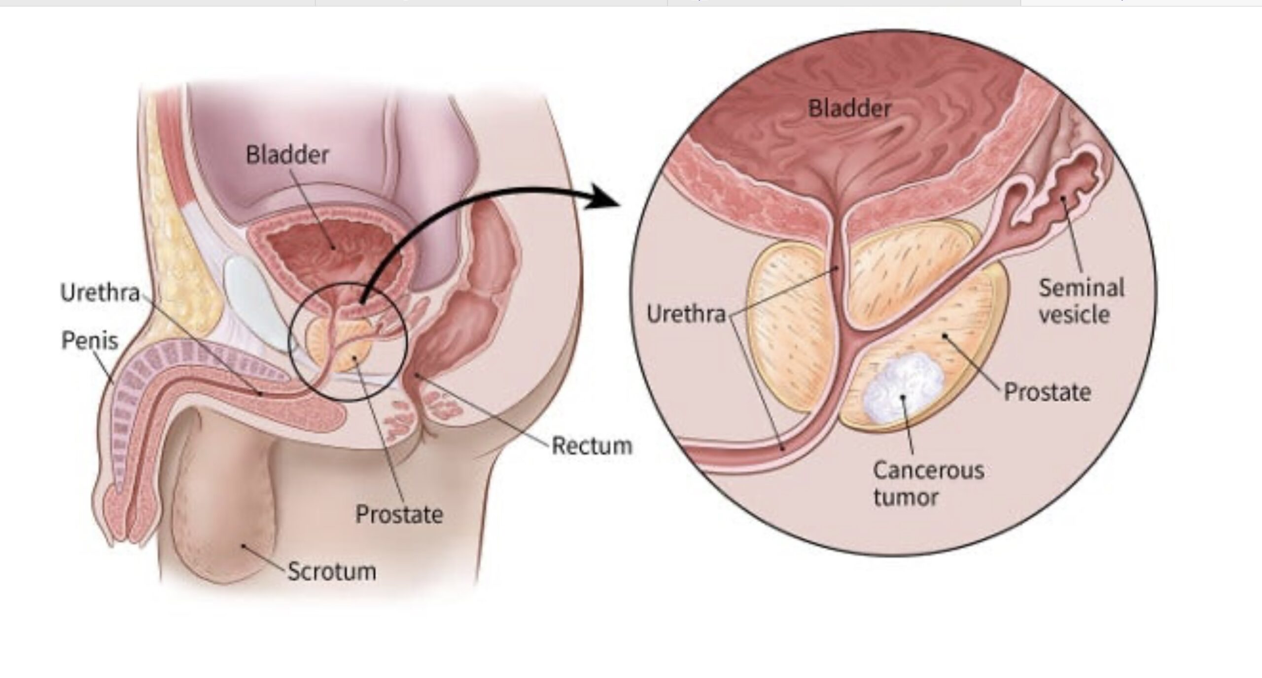 Prostate Cancer