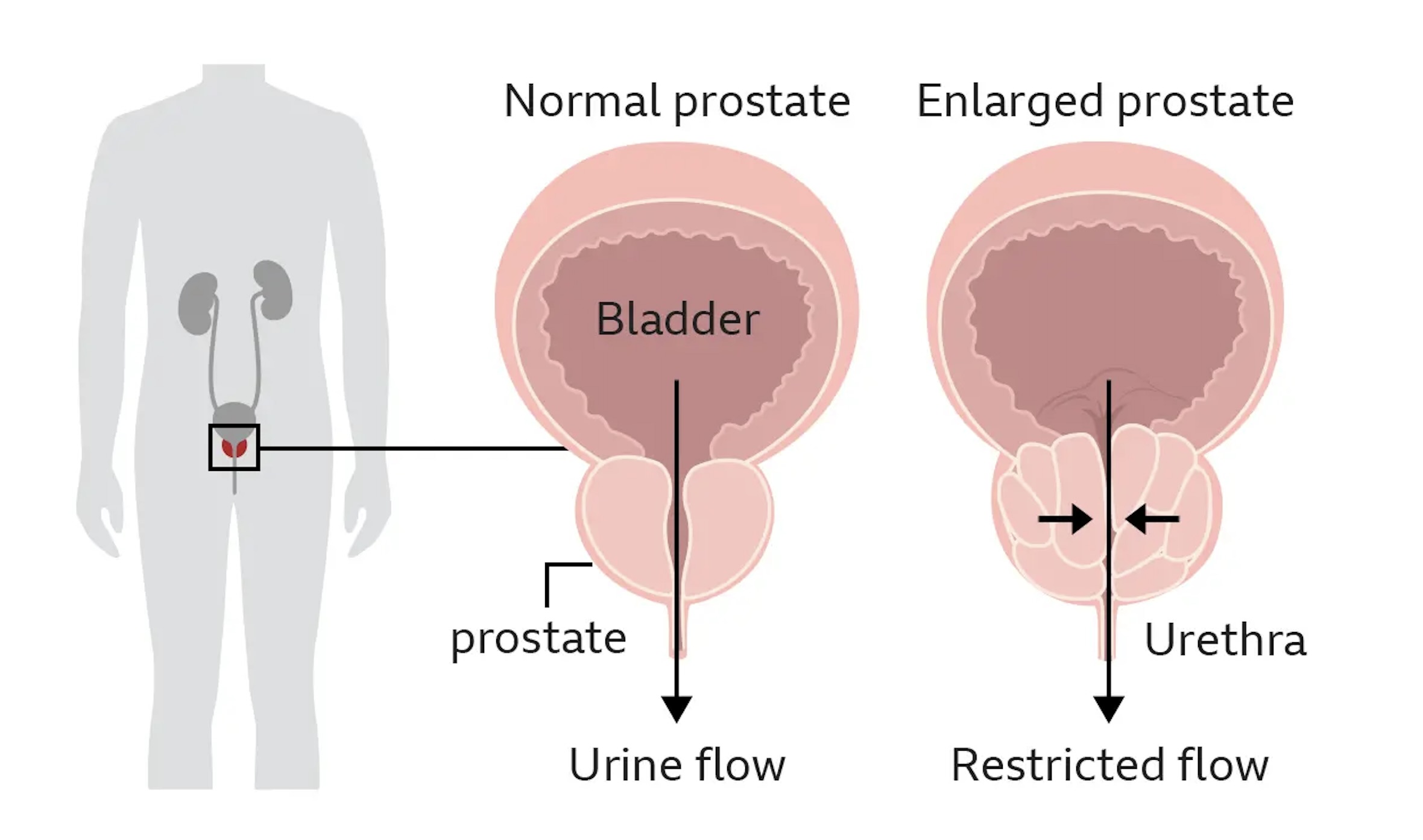 Prostate enlargement